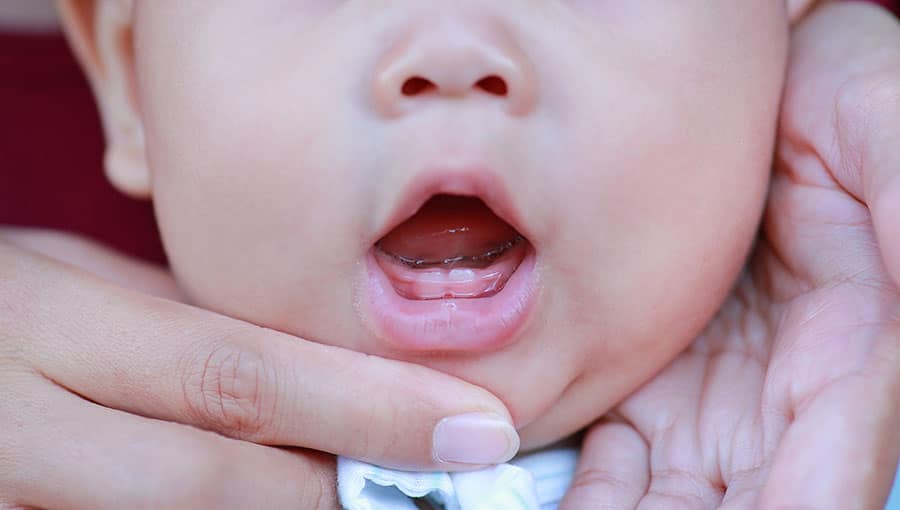 嬰幼兒蛀牙的成因, 預防及治療方法 - 高露潔香港
