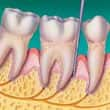 	AdvancedPeriodontis